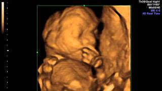 Mini 3D Video Of Boston. 20 Week Ultrasound.