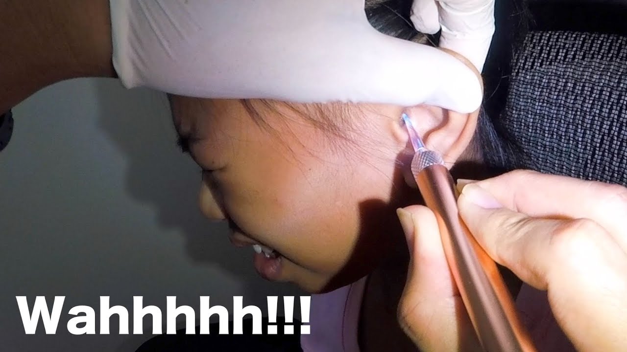 Girl's Driedup Earwax Removal Using A New Ear Curette Kit from