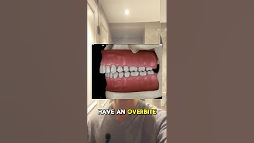How to fix overbite naturally #looksmaxxing #mewing