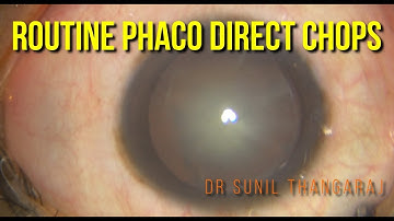 Routine phaco - Direct vertical chops