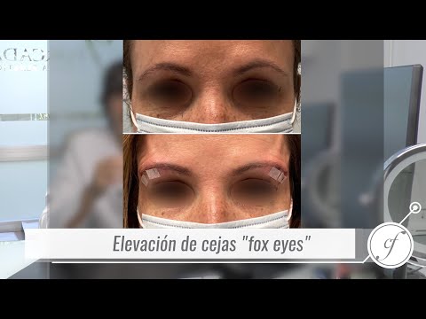 Elevación de cejas