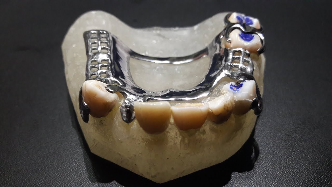 ELABORACIÓN DEL ESQUELETO METÁLICO DE UNA PPR EN CROMO-COBALTO