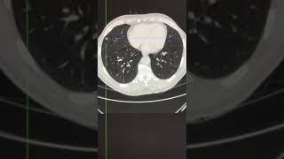 CT assessment - intrapulmonary lymph nodes Ct Thoracic Lymph Nodes