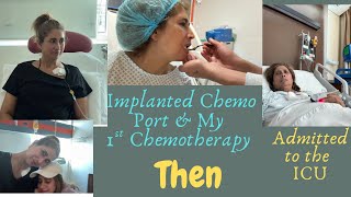 Download Lagu Implanted Chemo Port \u0026 1 Chemotherapy  MP3
