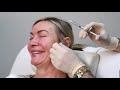 Botox and filler used to treat lower face and neck laxity