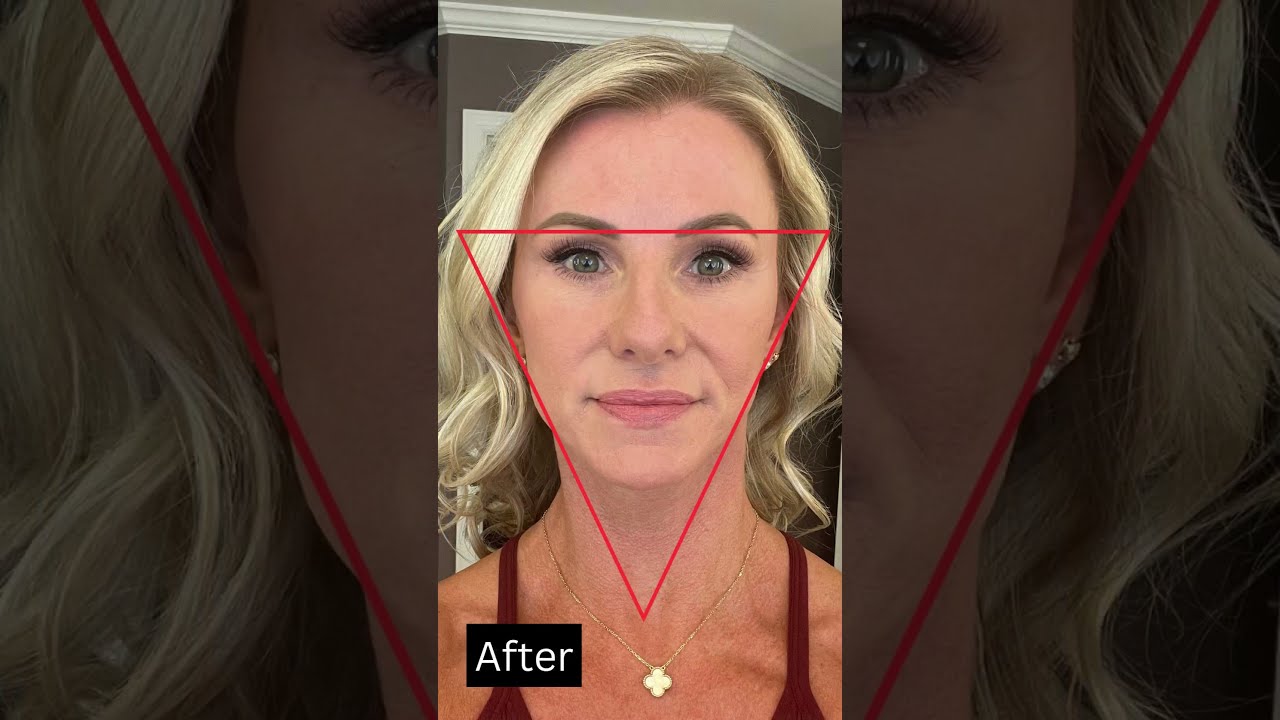 DRAMATIC Facelift Before And After She LOOKS 15 YEARS YOUNGER 
