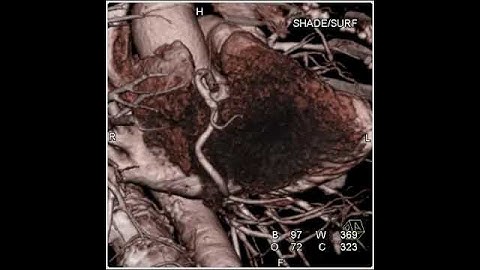 Cardiac: Coronary CTA (1 of 1)