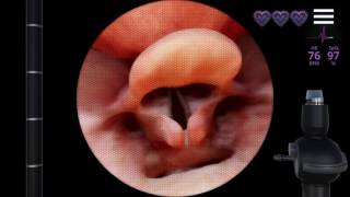 Airway EX Trailer