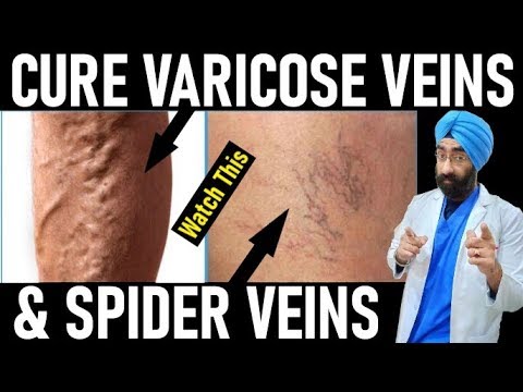 varicose-veins-vs-spider-veins-|-everything-you-need-to-know-|-dr.education-(hindi-+-eng)