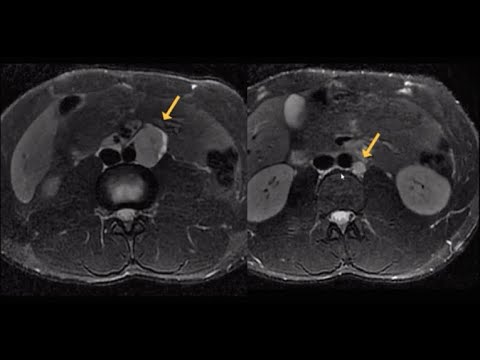 Vídeo: Qual é a diferença entre seminoma e não seminoma?