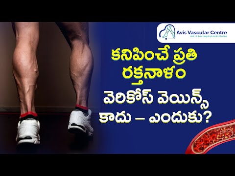 Avis Hospitals | Why Not All Visible Veins Are Varicose Veins | Avis Hopitals | Dr Soujanya