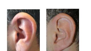 Earlobe Reduction Surgery