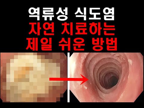 역류성 식도염 자연 치료하는  방법