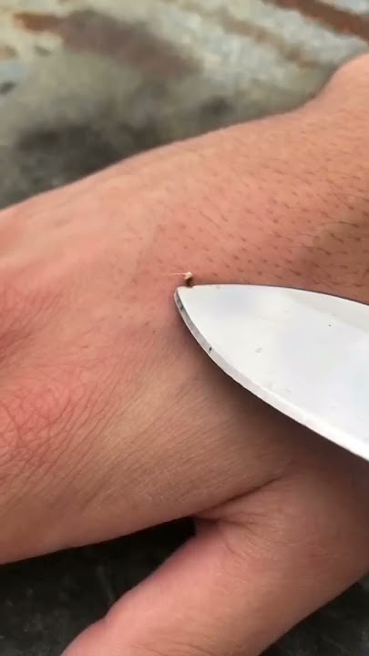 Things To be done After a Bee Sting!