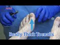 Really Thick Toenail (2020)