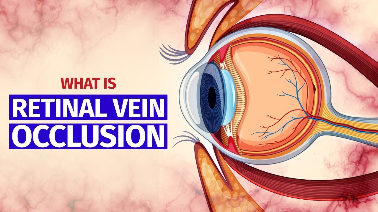 What is Retinal Vein Occlusion - Symptoms, Treatment and More.. - YouTube