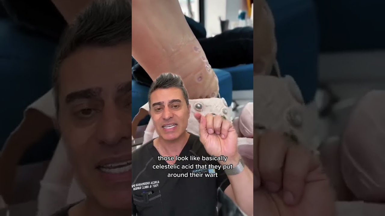 Shocking Plantar Wart Discovery 