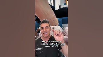 Shocking Plantar Wart Discovery!