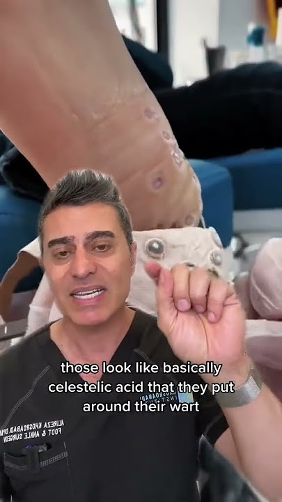 Shocking Plantar Wart Discovery!