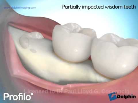 Impacted 20 Years Tooth Operation