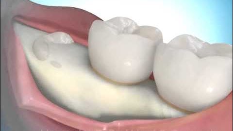 Removing Impacted Wisdom Teeth