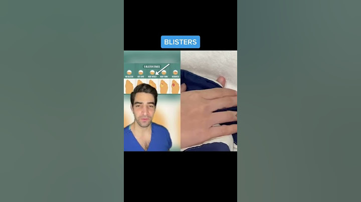 Blister