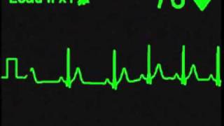 ECG Simulator - Sinus Rhythm with Baseline Wander