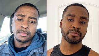 1 Year Minoxidil Beard: Plus How to Make Your Beard Darker