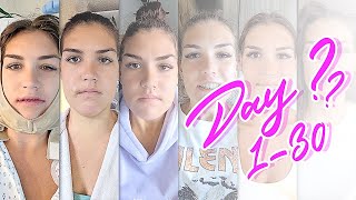 Day 1-30 After DOUBLE JAW SURGERY (Jaw Surgery Recovery Timeline) Ep. 6