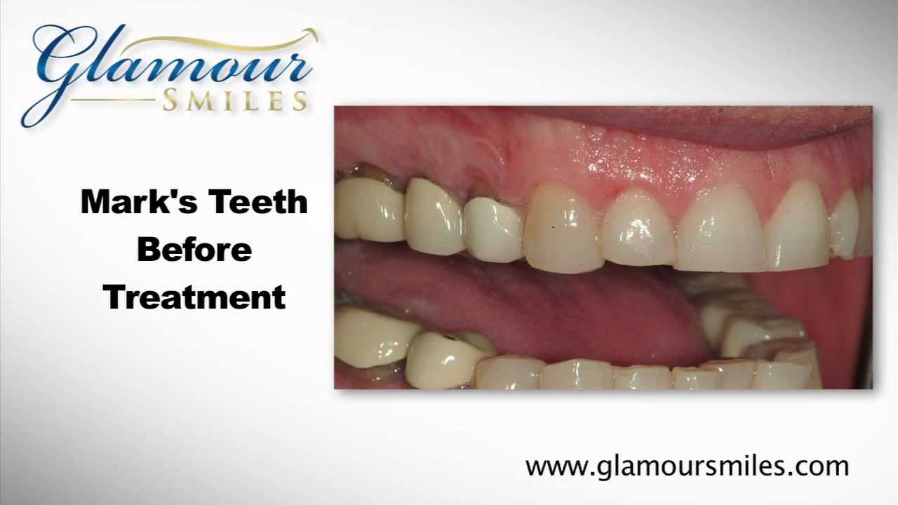 Cosmetic Full Mouth Rehabilitation from Palatine, Illinois and Implant