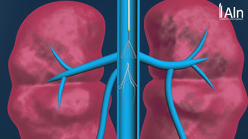 Removal& repositionning kit ALN