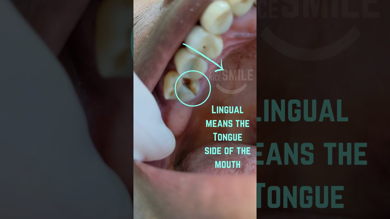 Broken Tooth Removed Dentist Extraction Verynicesmiledental