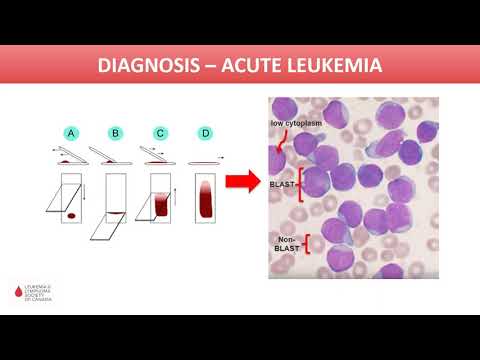 Video: Coesistenza Di IAMP21 Ed ETV6-RUNX1 In Un Adolescente Con Leucemia Linfoblastica Acuta A Cellule B: Revisione Della Letteratura Di Sei Casi Aggiuntivi