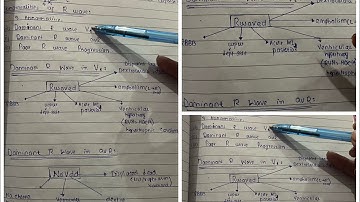 R wave# progression#abnormalities#dominant R wave # poor R wave progression