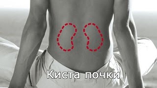 Киста почки Киста почки