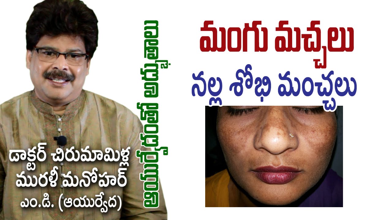 Dark Patches on Your Face? మంగు మచ్చలా? | Prof. Dr. Murali Manohar Chirumamilla, M.D. (Ayurveda)