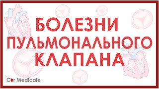 Болезни пульмонального клапана: стеноз и регургитация/недостаточность клапана.