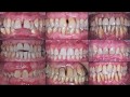 « Maladie parodontale et migrations secondaires » par le Dr Antoine POPELUT