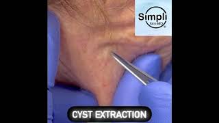 Cyst Extraction