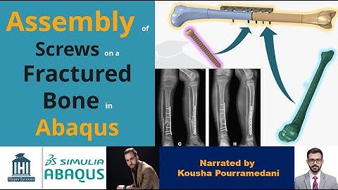 Abaqus Assembly of Screws on a Fractured Bone