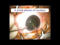 Cataract coaxial surgery 👁️