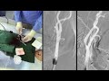 Balloon-Guide Catheter Protected Carotid Stenting