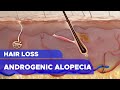 Hair loss androgenic alopecia