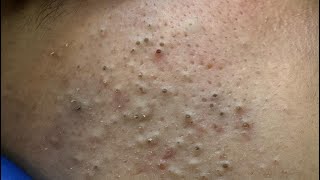 Ultimate Facial Care Routine | Blackheads Removal & Natural Remedies For Glowing Skin