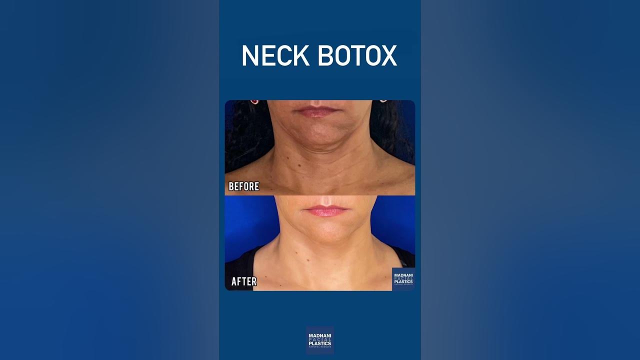Neck botox smooths out the lines on the neck by injecting into the