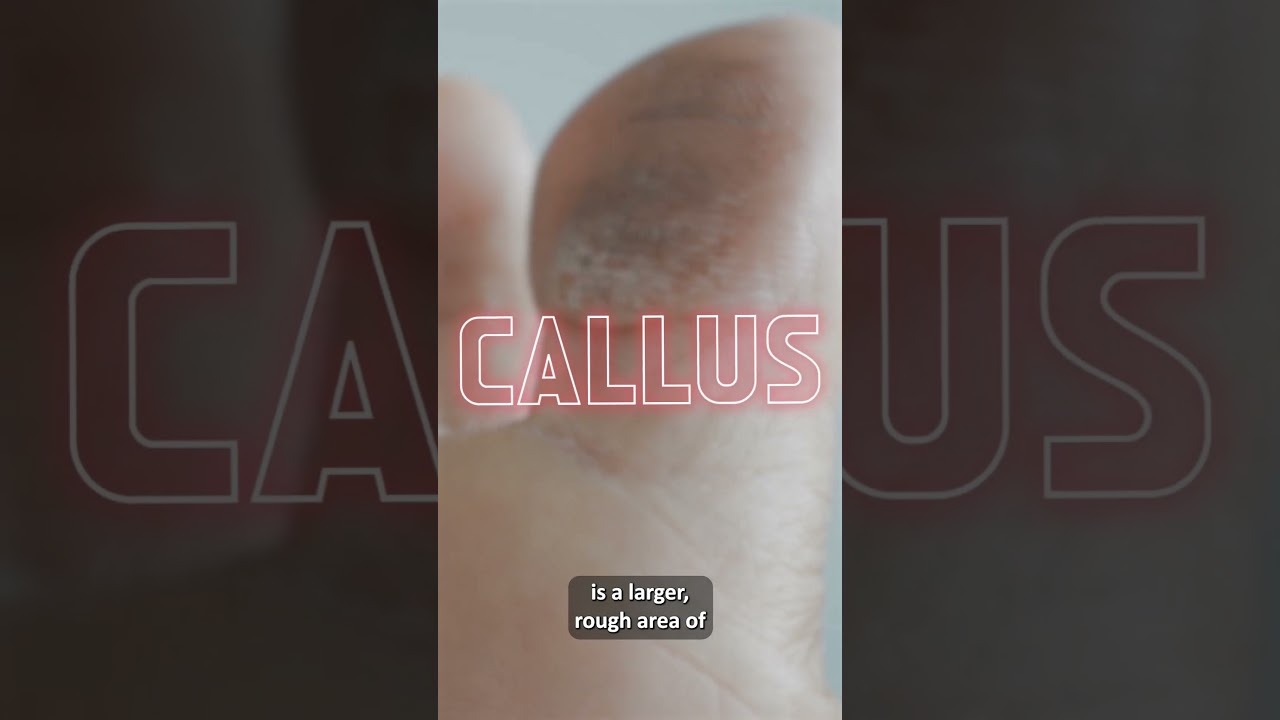 A Guide to Differences Between Corn vs. Callus vs. Bunion. Know the Difference!