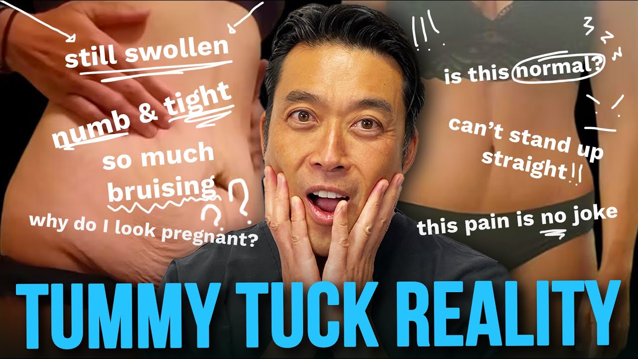 Tummy Tuck Recovery  REALITY CHECK: It’s Not What You Think!