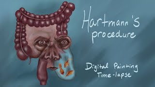 Hartmann's Procedure - Digital Painting Time-lapse