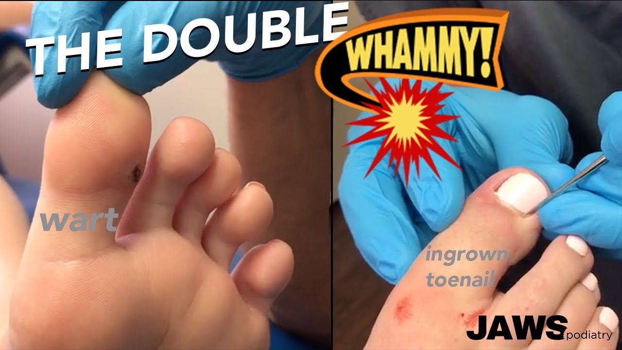 warts foot nails