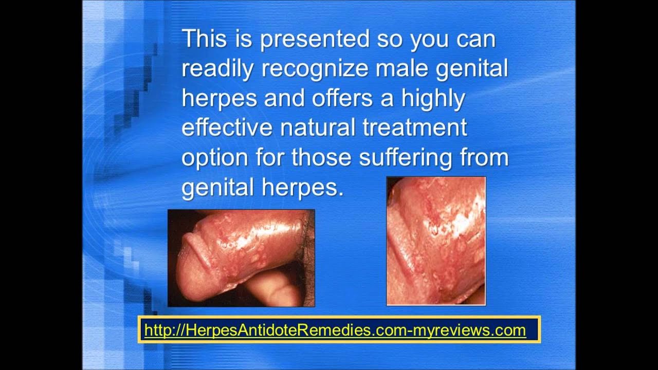 How to tell if i have herpes